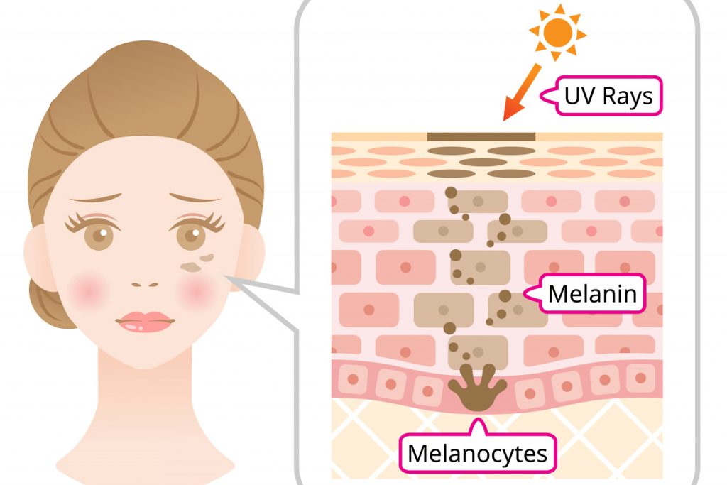 UV rays skin aging